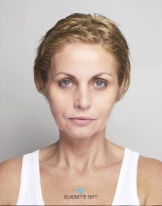 CATHERINE-MIDFACE-JAWLINE-before-marked-808x1024